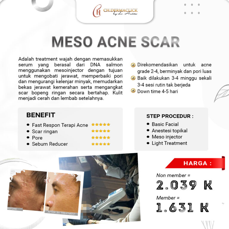 treatment-meso-acne-scar